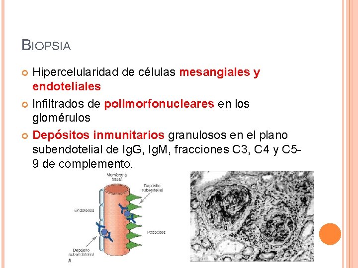 BIOPSIA Hipercelularidad de células mesangiales y endoteliales Infiltrados de polimorfonucleares en los glomérulos Depósitos