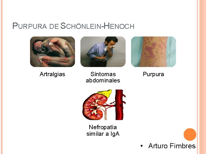 PURPURA DE SCHÖNLEIN-HENOCH Artralgias Síntomas abdominales Purpura Nefropatía similar a Ig. A • Arturo