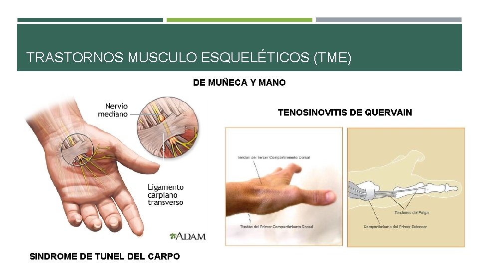TRASTORNOS MUSCULO ESQUELÉTICOS (TME) DE MUÑECA Y MANO TENOSINOVITIS DE QUERVAIN SINDROME DE TUNEL TRASTORNOS MUSCULO ESQUELÉTICOS (TME) DE MUÑECA Y MANO TENOSINOVITIS DE QUERVAIN SINDROME DE TUNEL