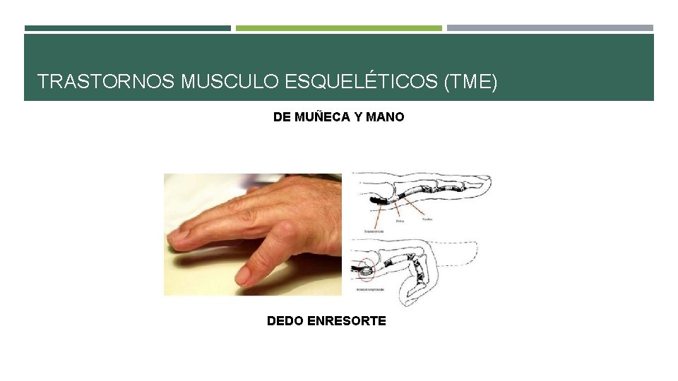 TRASTORNOS MUSCULO ESQUELÉTICOS (TME) DE MUÑECA Y MANO DEDO ENRESORTE TRASTORNOS MUSCULO ESQUELÉTICOS (TME) DE MUÑECA Y MANO DEDO ENRESORTE