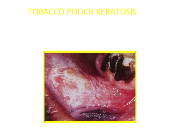 NICOTINE STOMATITIS SMOKERS PALATE STOMATITIS NICOTINA PALATI NICOTINE