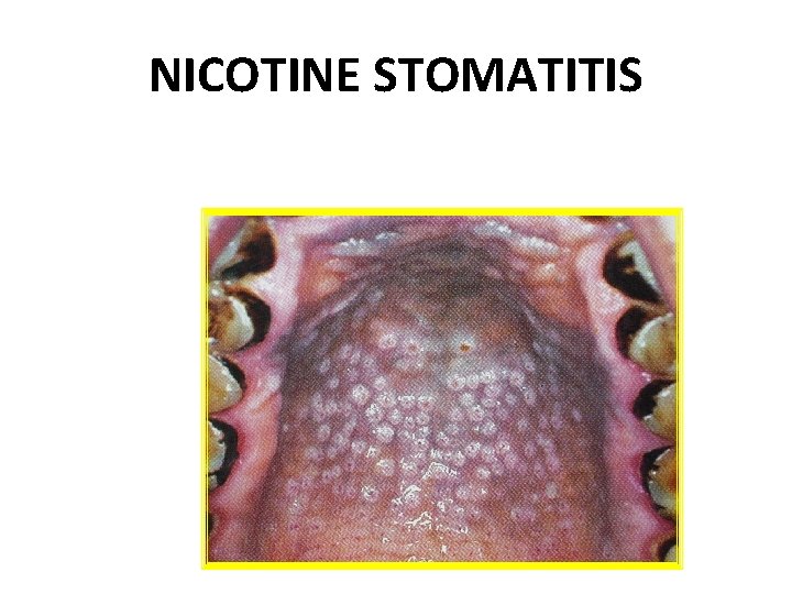 NICOTINE STOMATITIS 