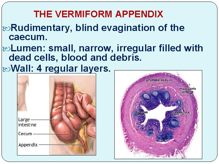 THE VERMIFORM APPENDIX Rudimentary, blind evagination of the caecum. Lumen: small, narrow, irregular filled