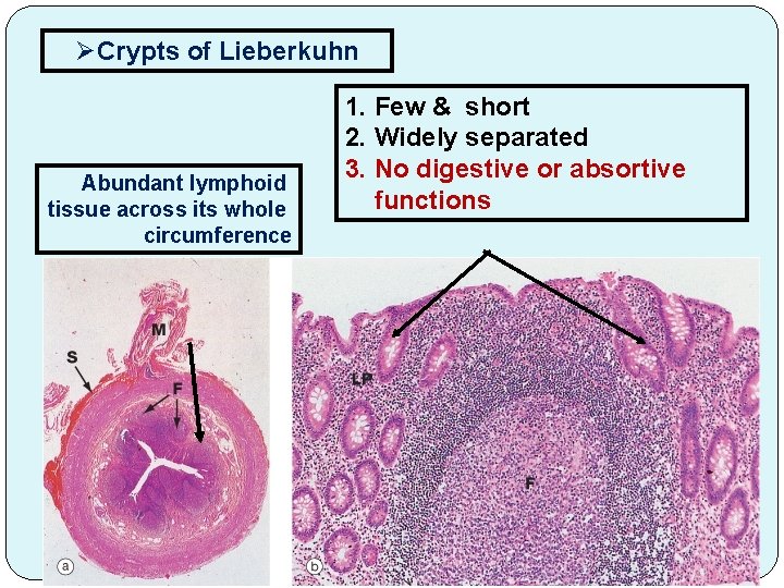 ØCrypts of Lieberkuhn Abundant lymphoid tissue across its whole circumference 1. Few & short