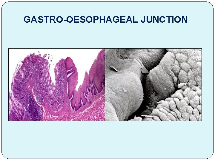  GASTRO-OESOPHAGEAL JUNCTION 