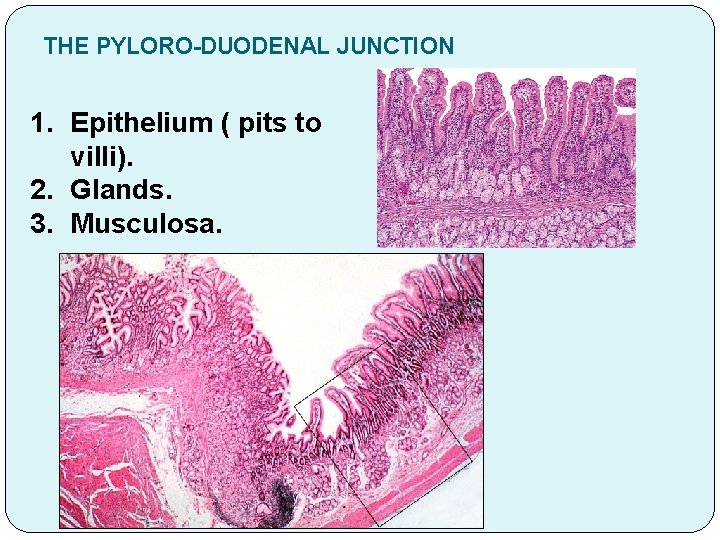 THE PYLORO-DUODENAL JUNCTION 1. Epithelium ( pits to villi). 2. Glands. 3. Musculosa. 