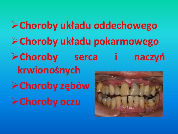 ØChoroby układu oddechowego ØChoroby układu pokarmowego ØChoroby serca i naczyń krwionośnych ØChoroby zębów ØChoroby