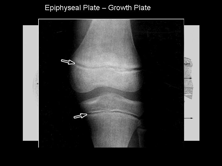 Epiphyseal Plate – Growth Plate 