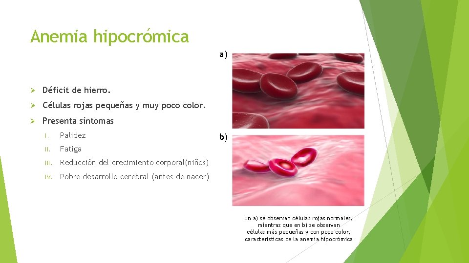 Anemia hipocrómica a) Déficit de hierro. Células rojas pequeñas y muy poco color. Presenta