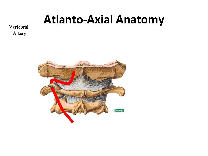 Vertebral Artery Atlanto-Axial Anatomy 