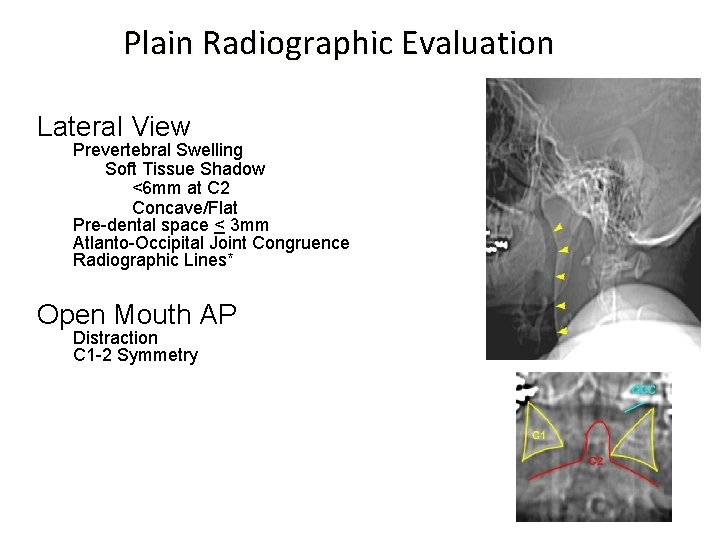 Plain Radiographic Evaluation Lateral View Prevertebral Swelling Soft Tissue Shadow <6 mm at C