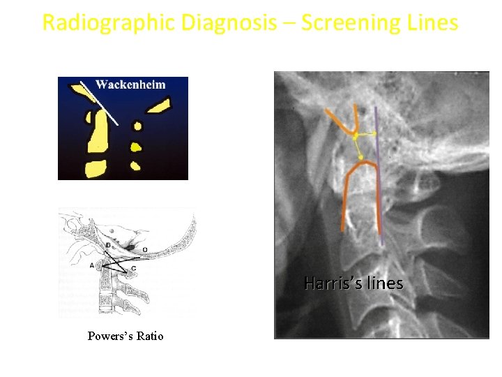 Radiographic Diagnosis – Screening Lines Harris’s lines Powers’s Ratio 