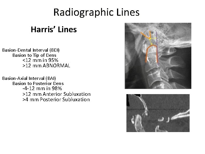 Radiographic Lines Harris’ Lines Basion-Dental Interval (BDI) Basion to Tip of Dens <12 mm