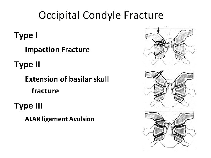 Occipital Condyle Fracture Type I Impaction Fracture Type II Extension of basilar skull fracture