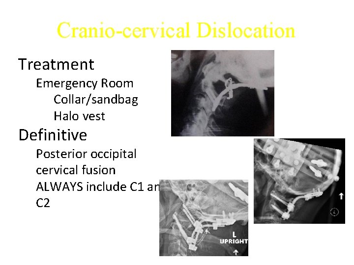 Cranio-cervical Dislocation Treatment Emergency Room Collar/sandbag Halo vest Definitive Posterior occipital cervical fusion ALWAYS