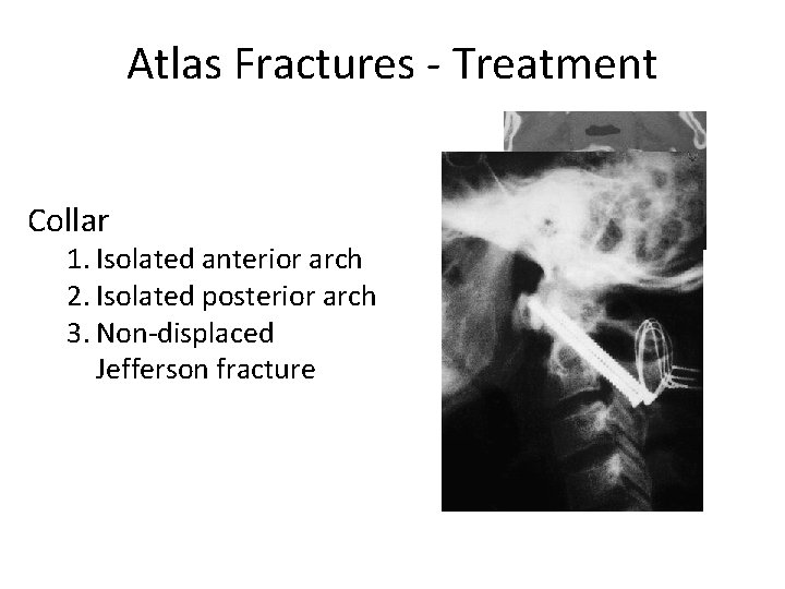 Atlas Fractures - Treatment Collar 1. Isolated anterior arch 2. Isolated posterior arch 3.