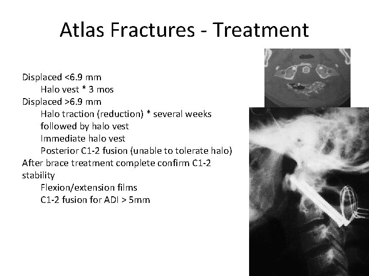 Atlas Fractures - Treatment Displaced <6. 9 mm Halo vest * 3 mos Displaced