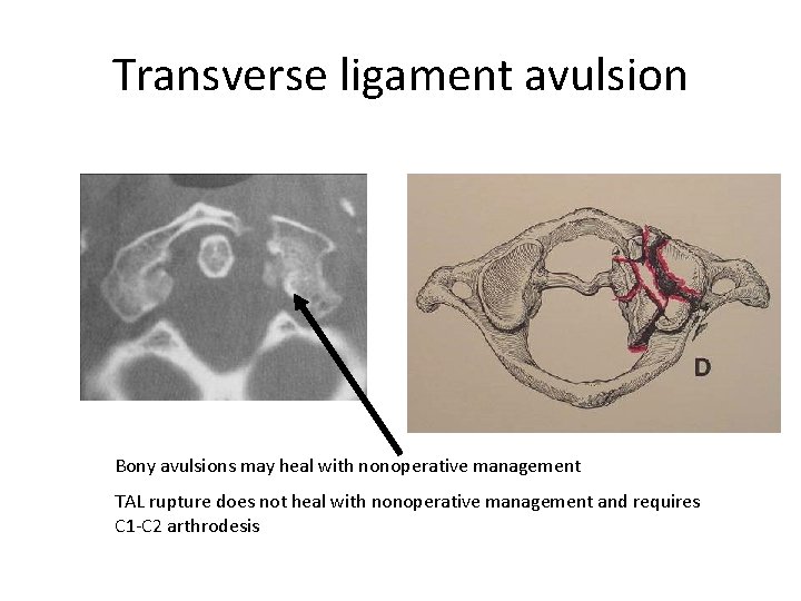 Transverse ligament avulsion Bony avulsions may heal with nonoperative management TAL rupture does not