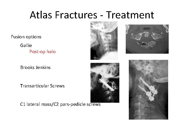 Atlas Fractures - Treatment Fusion options Gallie Post-op halo Brooks Jenkins Transarticular Screws C