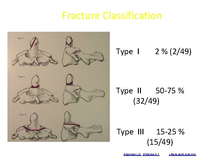 Fracture Classification Anderson and D’Alonzo Type I 2 % (2/49) Type II 50 -75