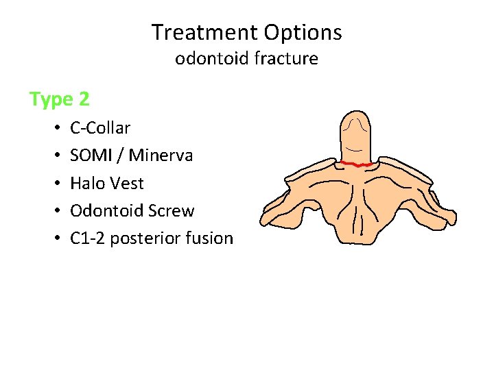 Treatment Options odontoid fracture Type 2 • • • C-Collar SOMI / Minerva Halo