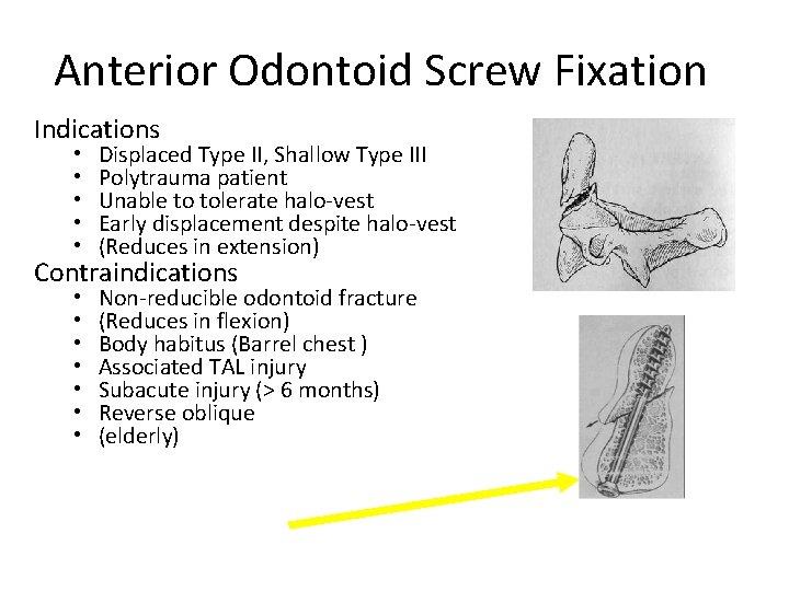 Anterior Odontoid Screw Fixation Indications • • • Displaced Type II, Shallow Type III