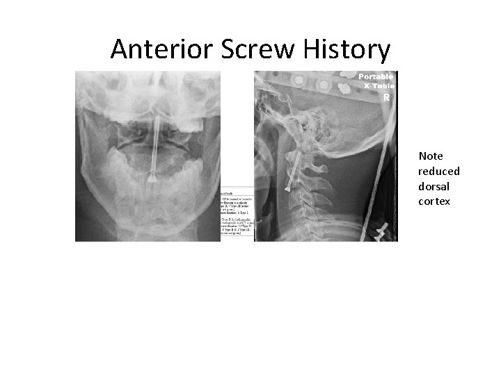 Anterior Screw History Note reduced dorsal cortex 