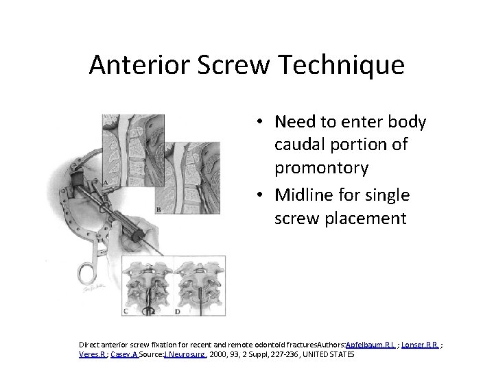 Anterior Screw Technique • Need to enter body caudal portion of promontory • Midline