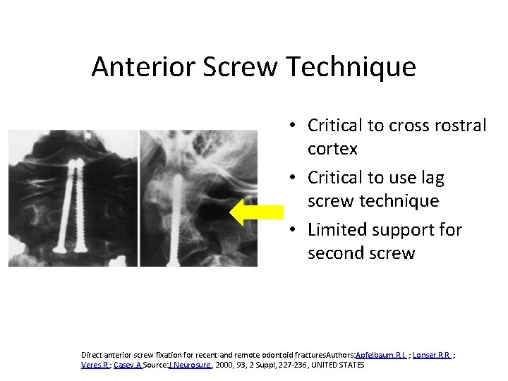 Anterior Screw Technique • Critical to cross rostral cortex • Critical to use lag