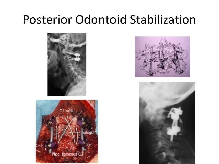 Posterior Odontoid Stabilization 