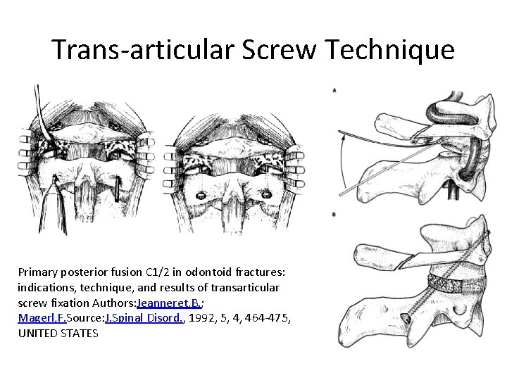 Trans-articular Screw Technique Primary posterior fusion C 1/2 in odontoid fractures: indications, technique, and