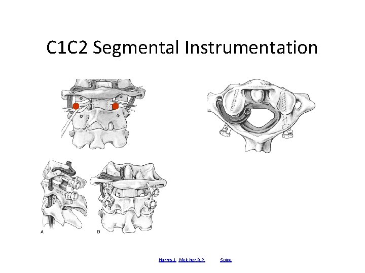 C 1 C 2 Segmental Instrumentation Posterior C 1 -C 2 fusion with polyaxial