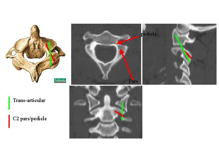 pedicle Pars Trans-articular C 2 pars/pedicle 