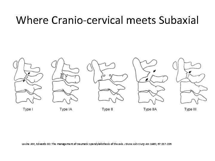 Where Cranio-cervical meets Subaxial Levine AM, Edwards CC: The management of traumatic spondylolisthesis of