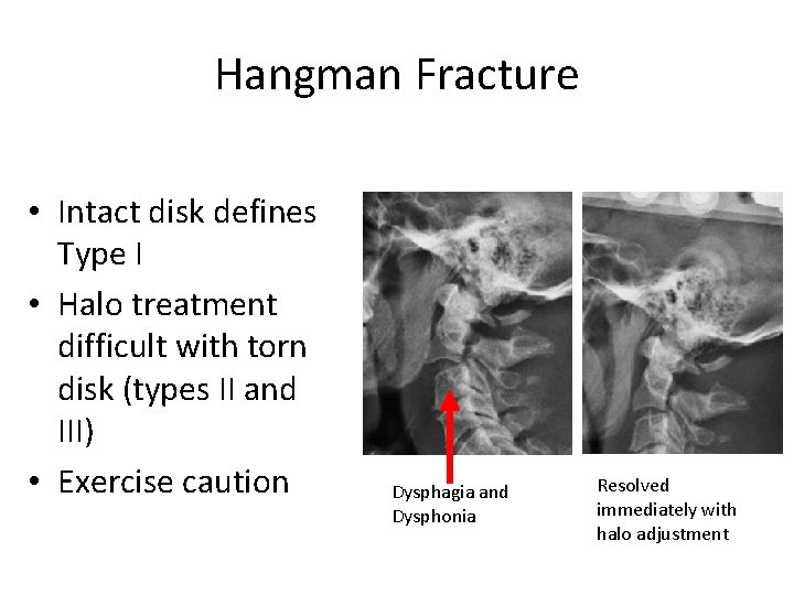 Hangman Fracture • Intact disk defines Type I • Halo treatment difficult with torn