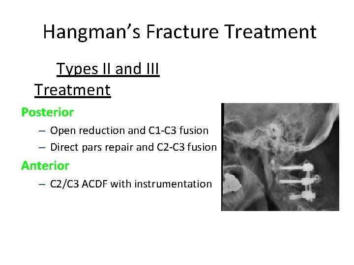 Hangman’s Fracture Treatment Types II and III Treatment Posterior – Open reduction and C