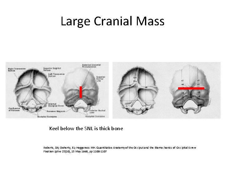 Large Cranial Mass Keel below the SNL is thick bone Roberts, DA; Doherty, BJ;