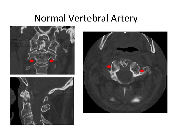 Normal Vertebral Artery 