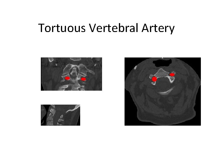 Tortuous Vertebral Artery 