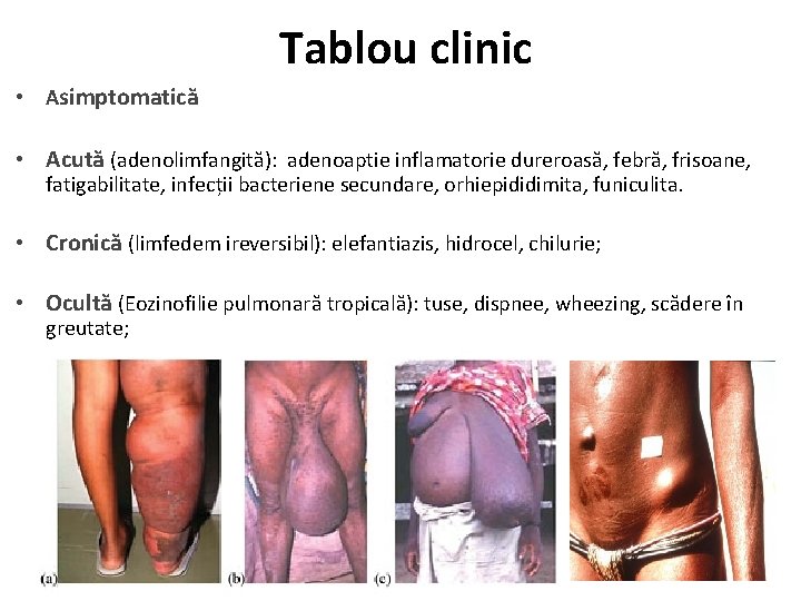 Tablou clinic • Asimptomatică • Acută (adenolimfangită): adenoaptie inflamatorie dureroasă, febră, frisoane, fatigabilitate, infecții