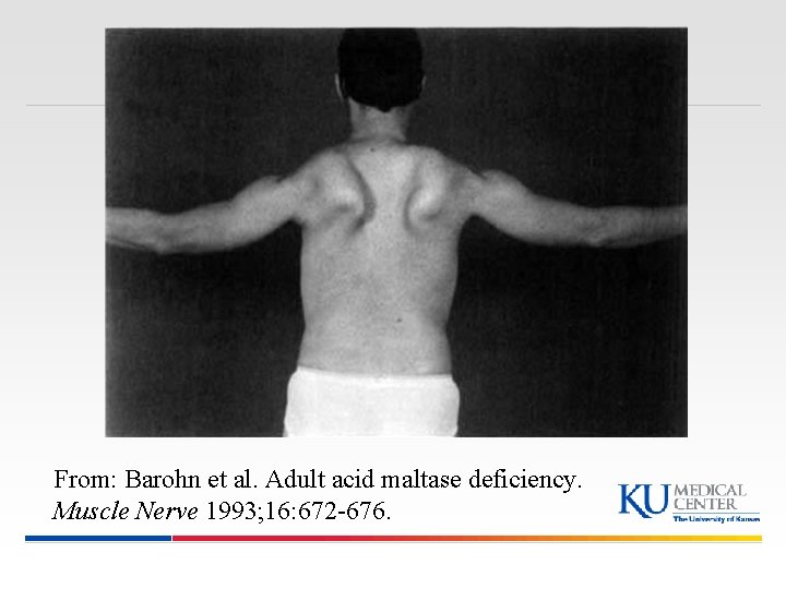 From: Barohn et al. Adult acid maltase deficiency. Muscle Nerve 1993; 16: 672 -676. From: Barohn et al. Adult acid maltase deficiency. Muscle Nerve 1993; 16: 672 -676.