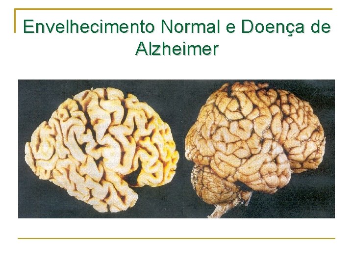 Envelhecimento Normal e Doença de Alzheimer 