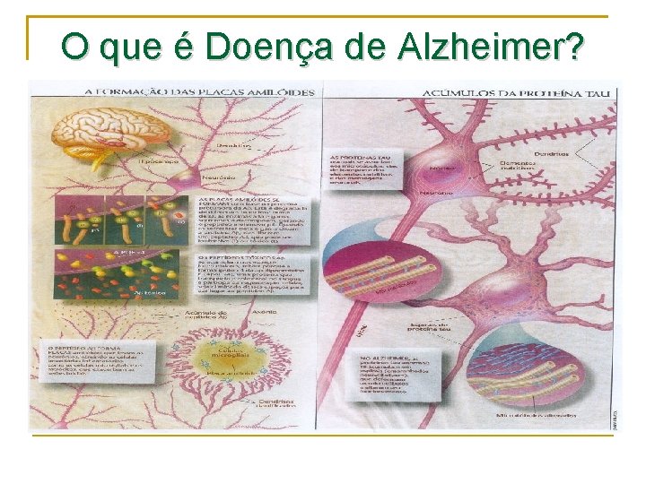 O que é Doença de Alzheimer? 