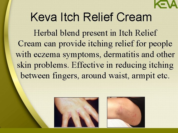 Keva Itch Relief Cream Herbal blend present in Itch Relief Cream can provide itching