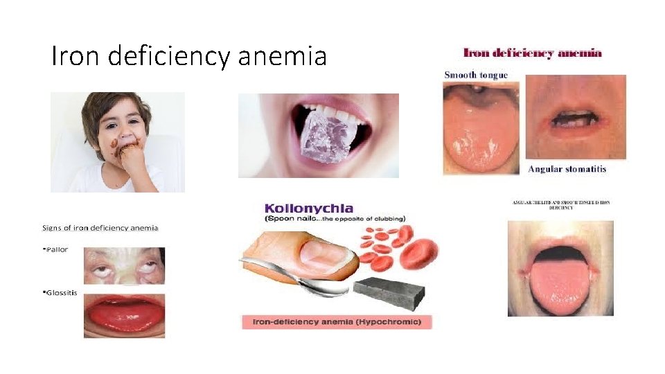 Iron deficiency anemia 