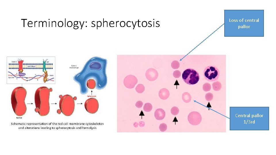 Terminology: spherocytosis Loss of central pallor Central pallor 1/3 rd 