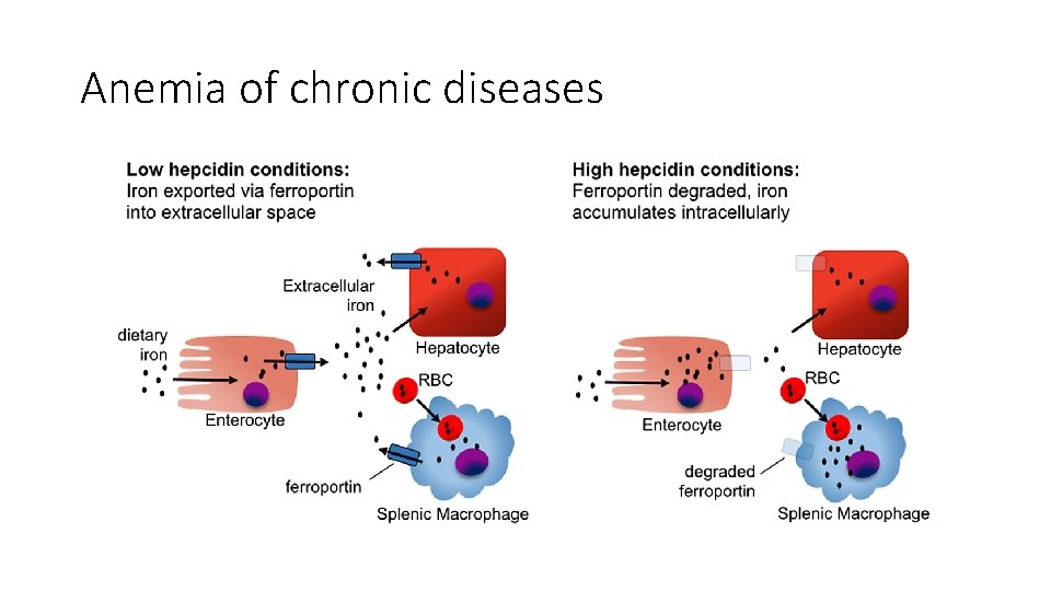 Anemia of chronic diseases 
