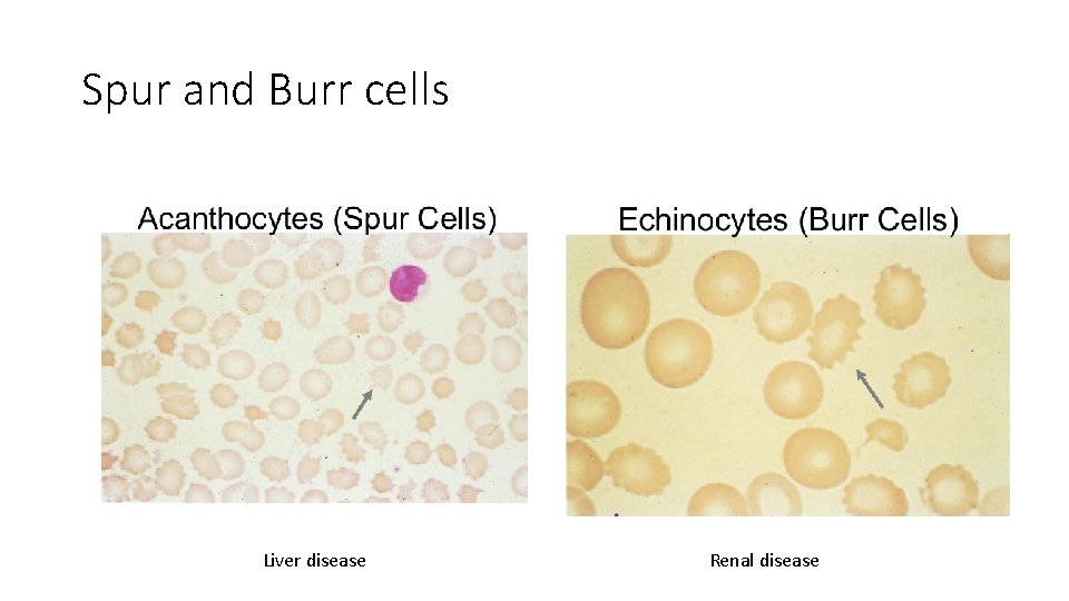 Spur and Burr cells Liver disease Renal disease 