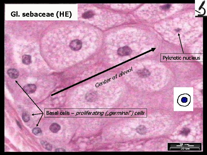 Gl. sebaceae (HE) Pyknotic nucleus of r nte e C ol e v al