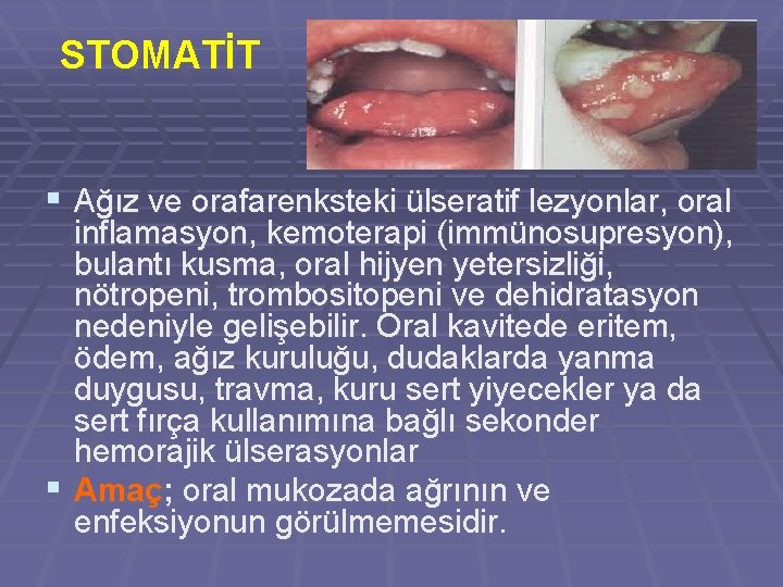 STOMATİT § Ağız ve orafarenksteki ülseratif lezyonlar, oral inflamasyon, kemoterapi (immünosupresyon), bulantı kusma, oral